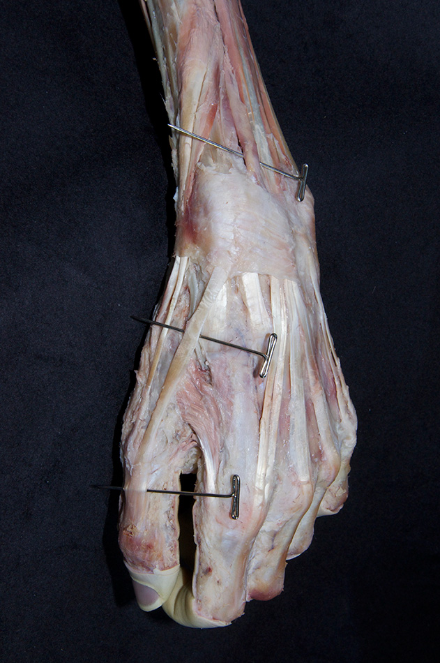 Extensor Pollicis Longus Muscle