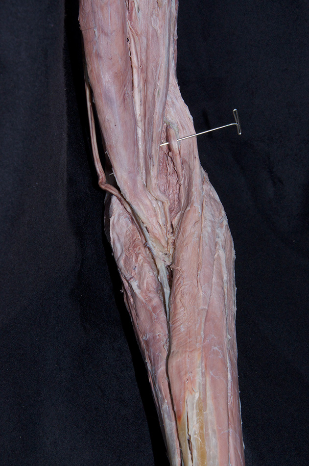 Radial Nerve at the Lateral Epicondyle