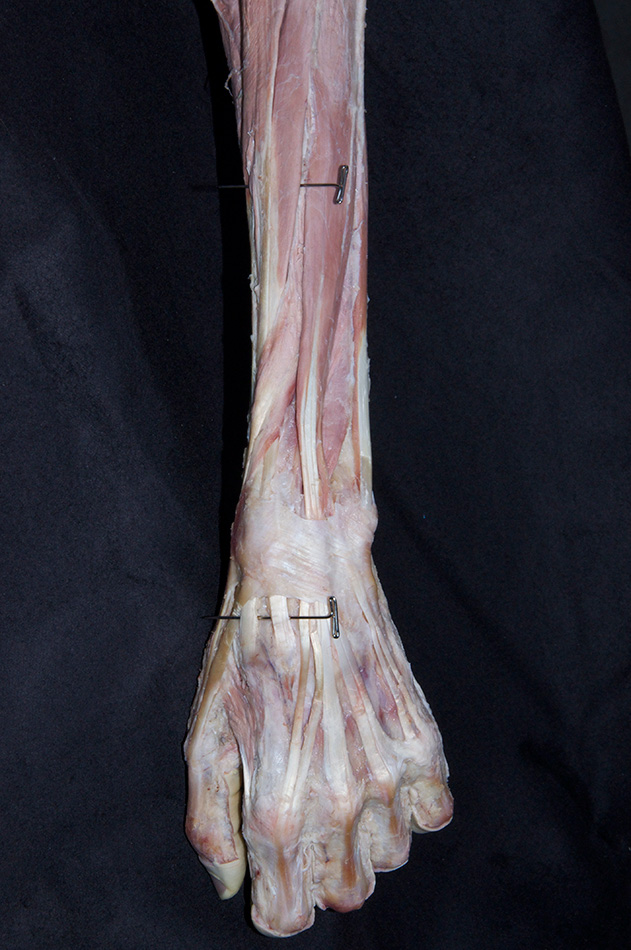 Extensor Carpi Radialis Longus and Brevis Muscles