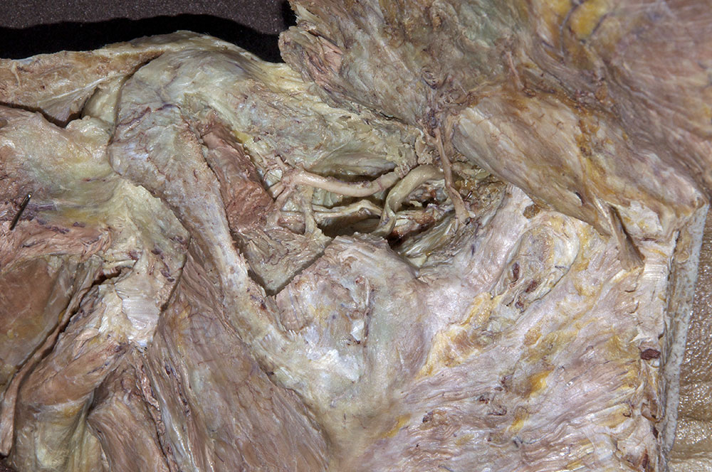 Superior Transverse Scapular Ligament