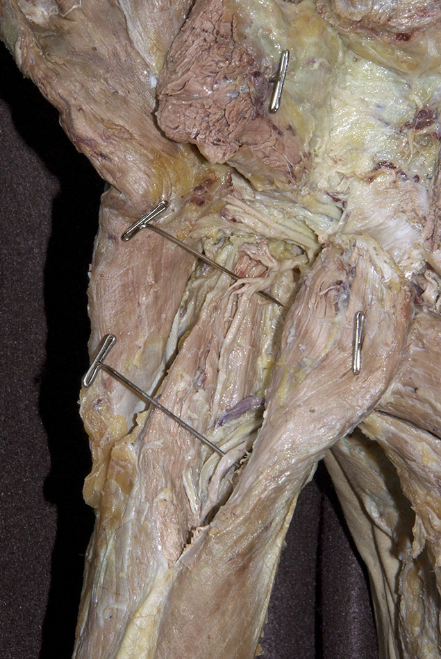 Posterior Circumflex Humeral Artery (Descending Branch)