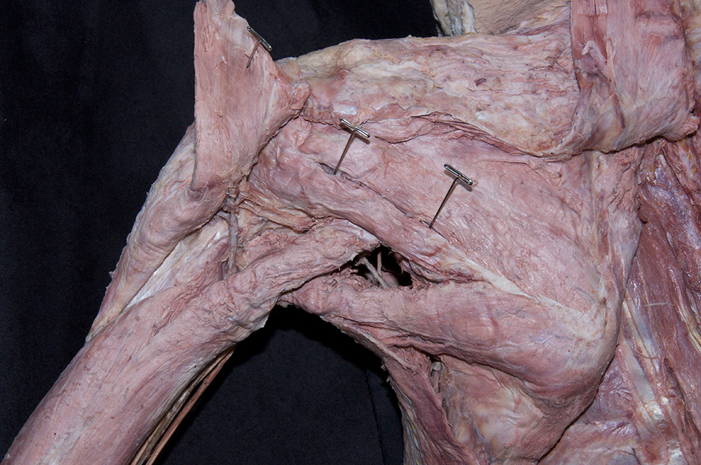 Infraspinatus Muscle