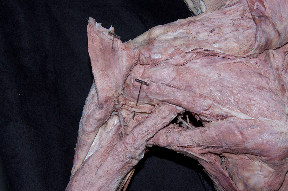 Axillary Nerve