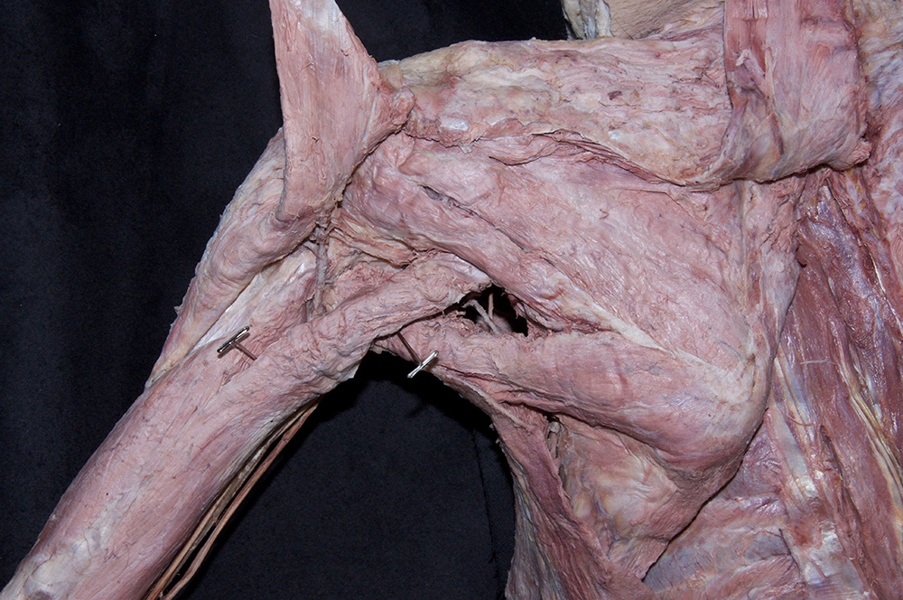 Triceps Muscle (long head)