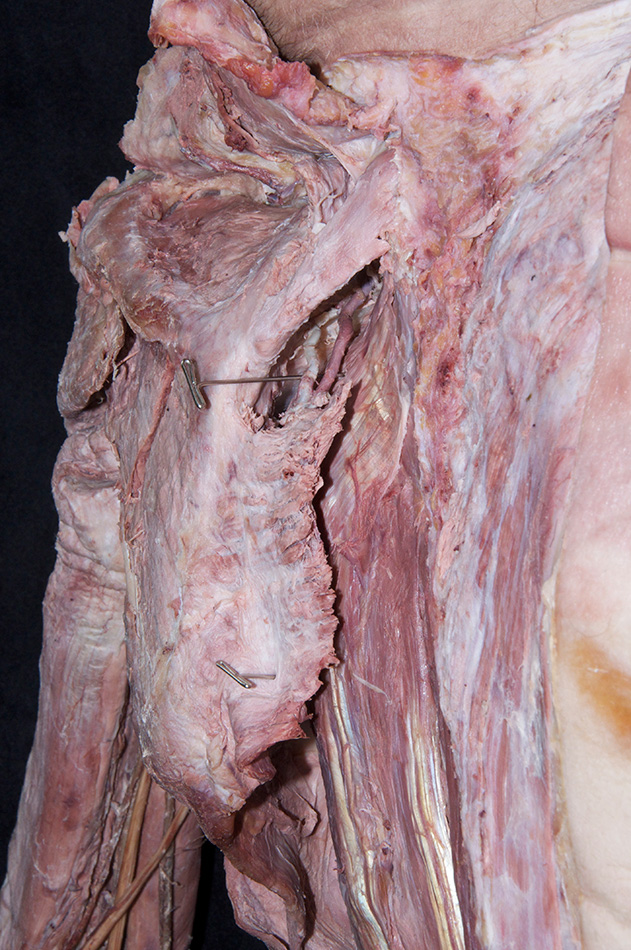 Dorsal Scapular Artery