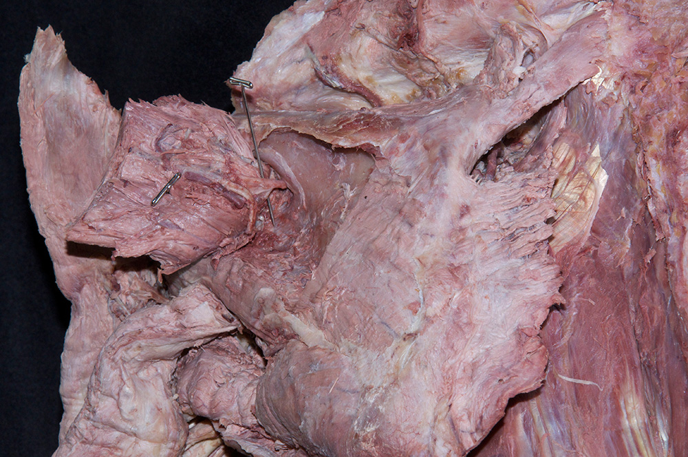 Suprascapular Nerve (at spinoglenoid notch)