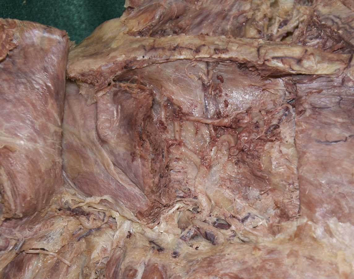Circumflex Scapular Artery