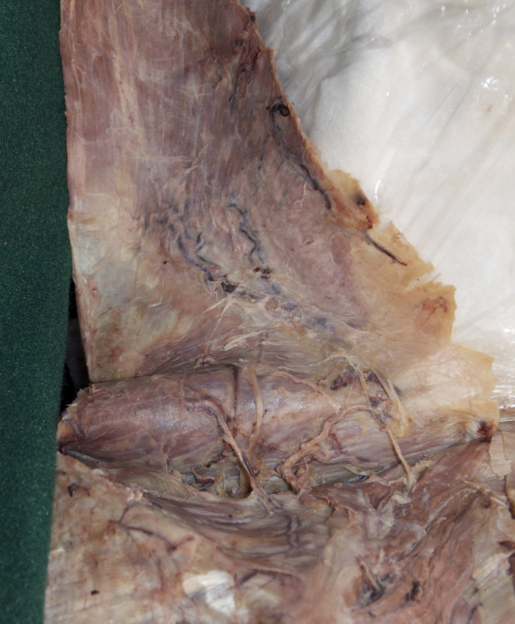 Accessory Nerve