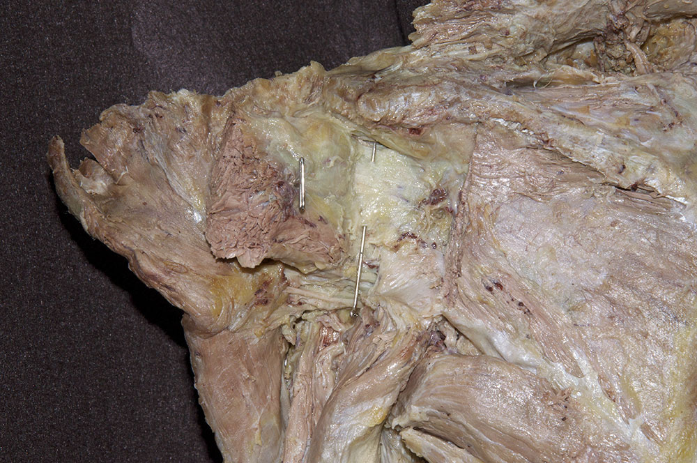 Left Posterior Joint Capsule