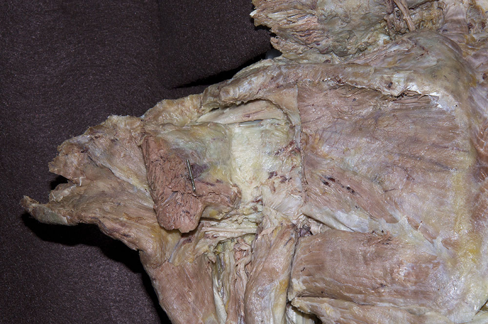 Supraspinatus Tendon
