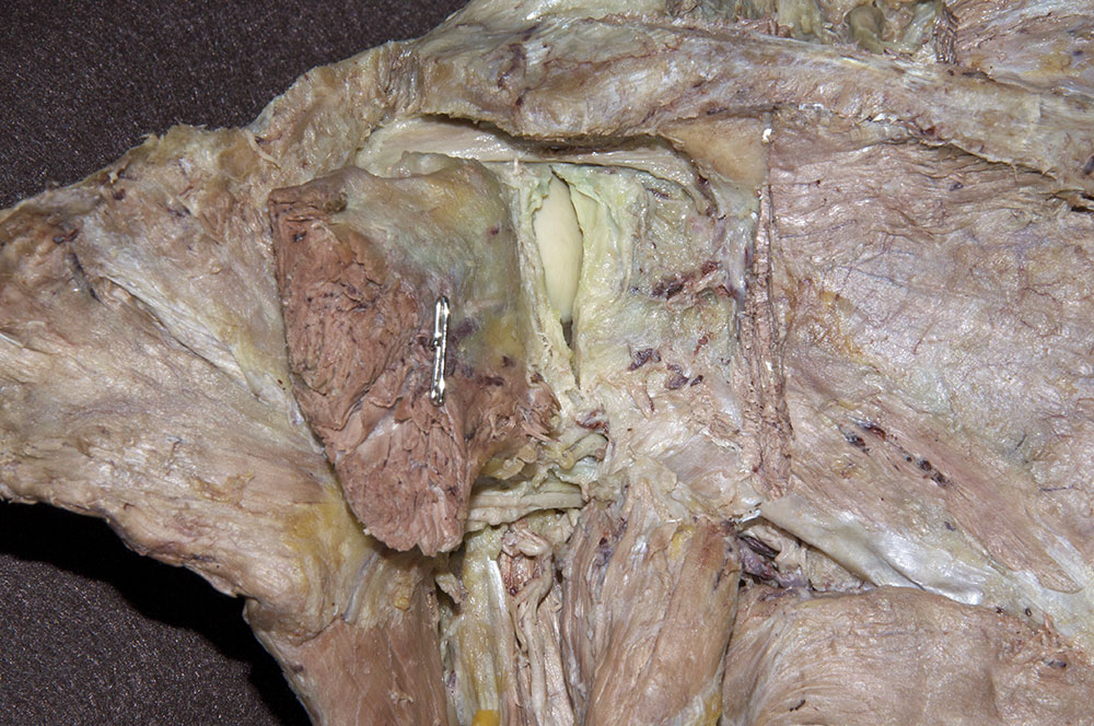 Opened Left Posterior Joint Capsule