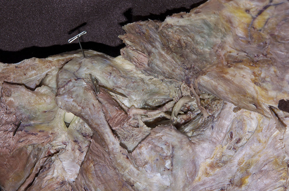 Coracoclavicular Ligament