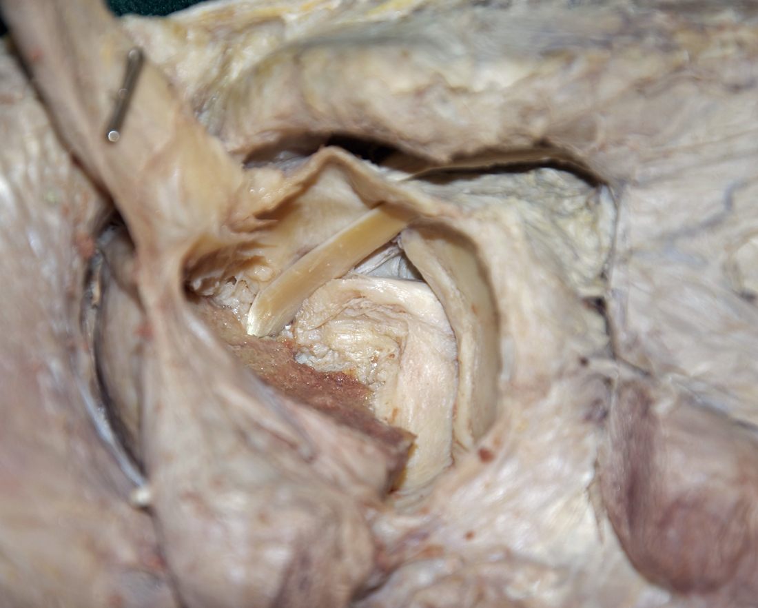 Left Shoulder Joint with Humeral Head Removed