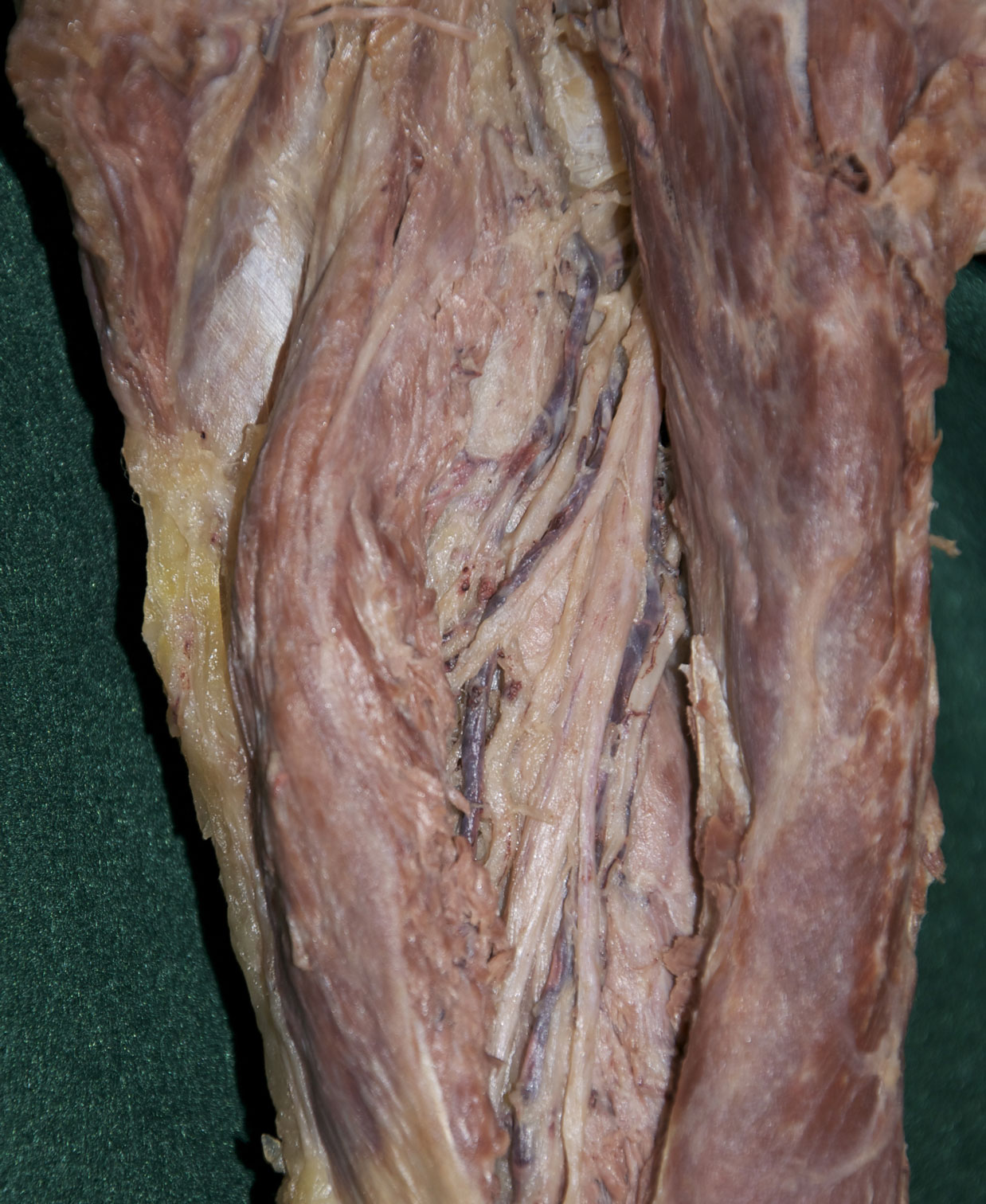 Posterior Arm - 1