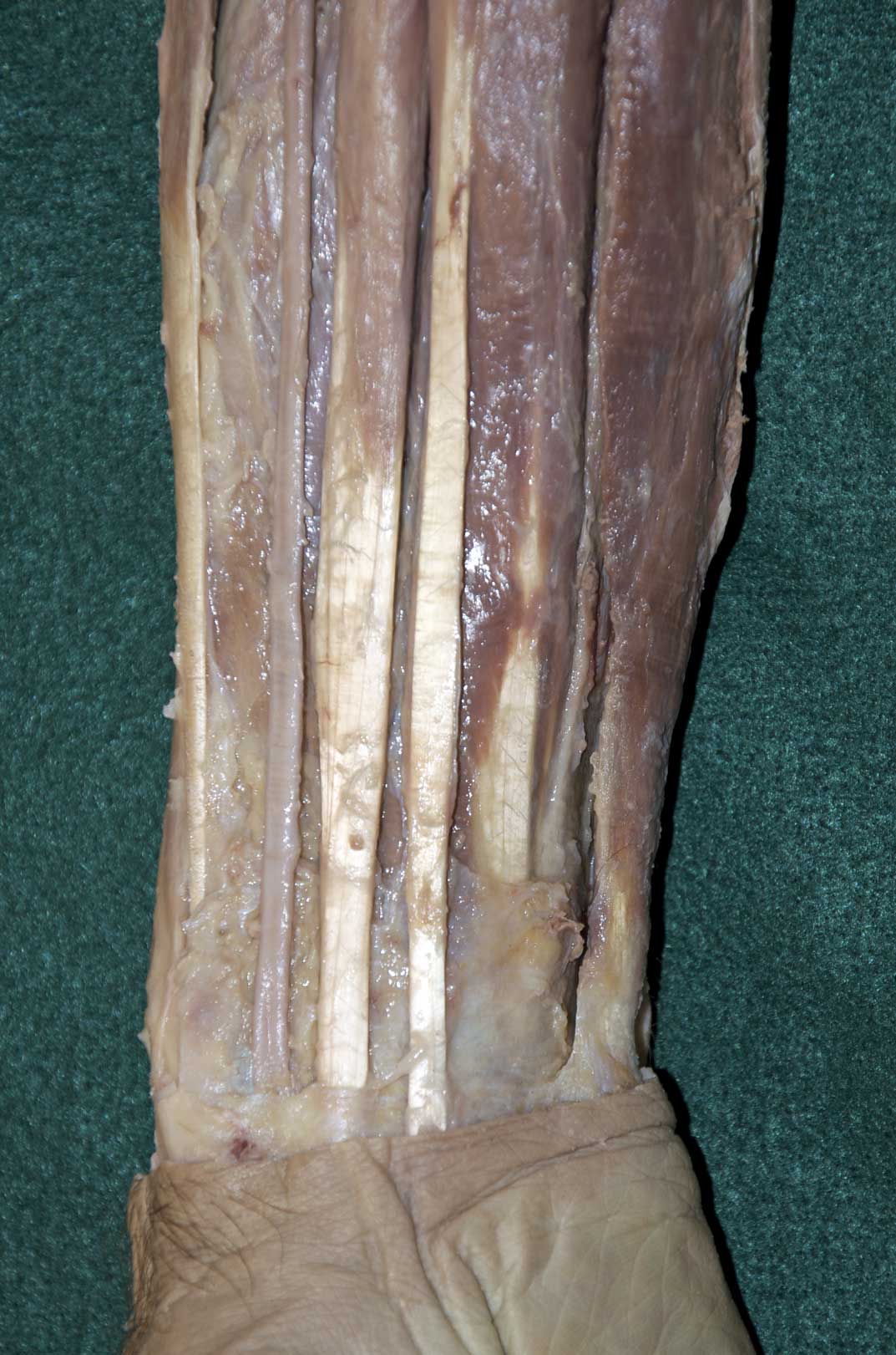 Anterior Forearm - 2