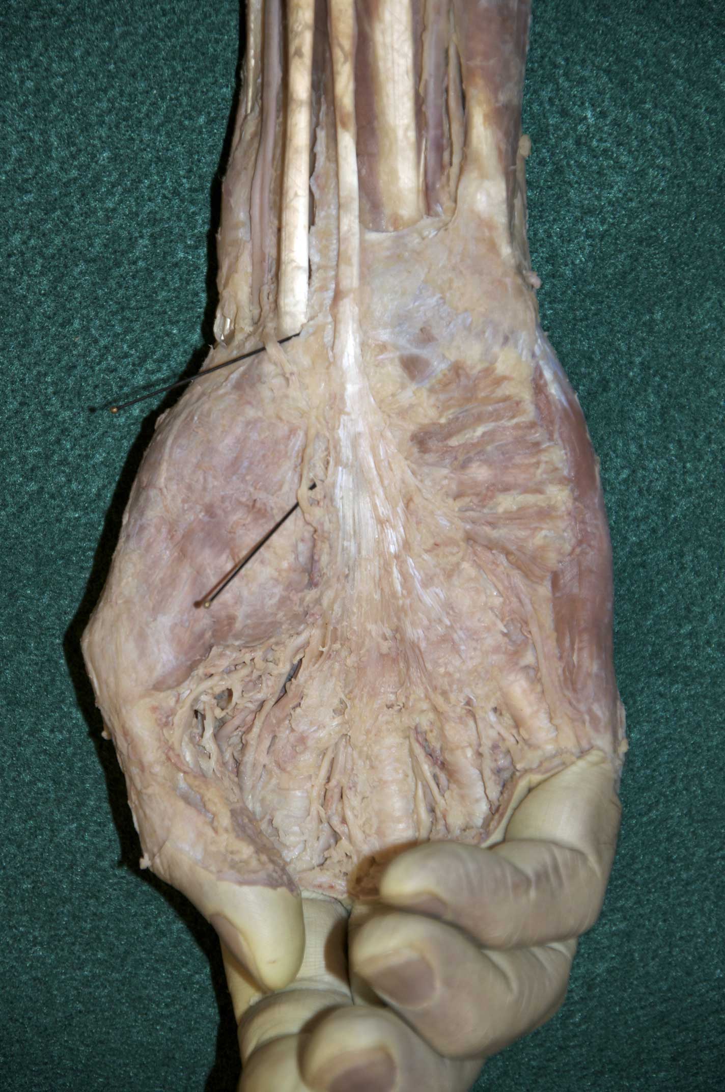 Superficial Palmar Hand - 1