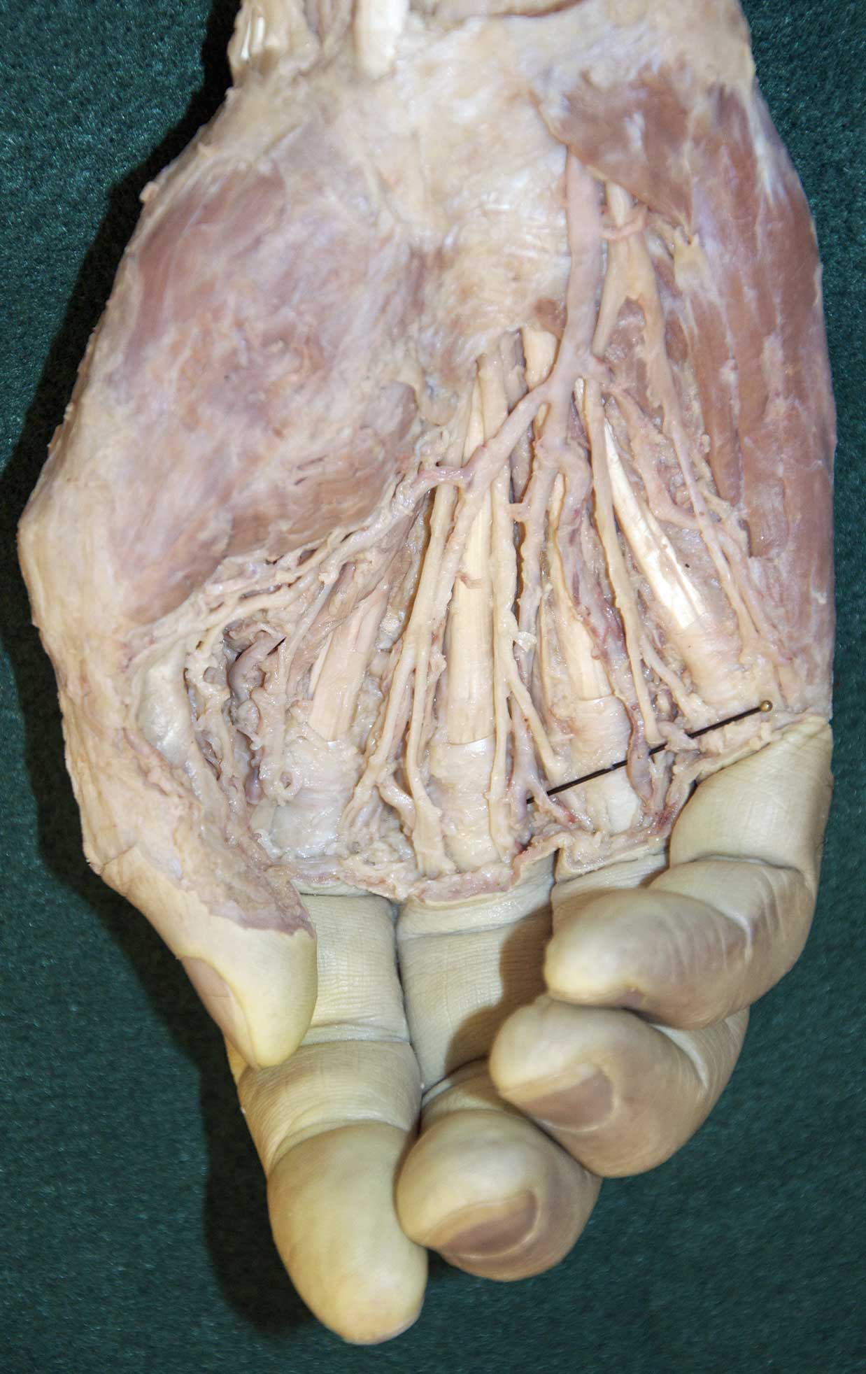 Superficial Palmar Hand - 2