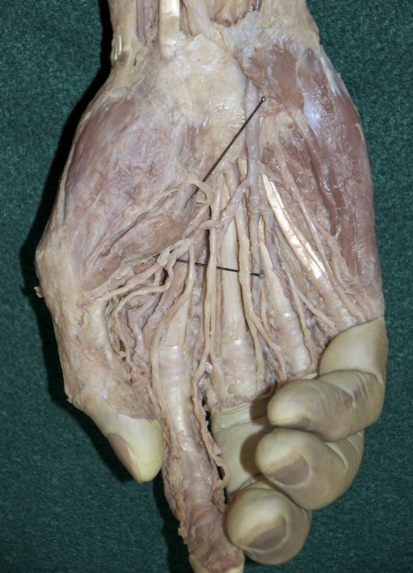 Superficial Palmar Hand - 4