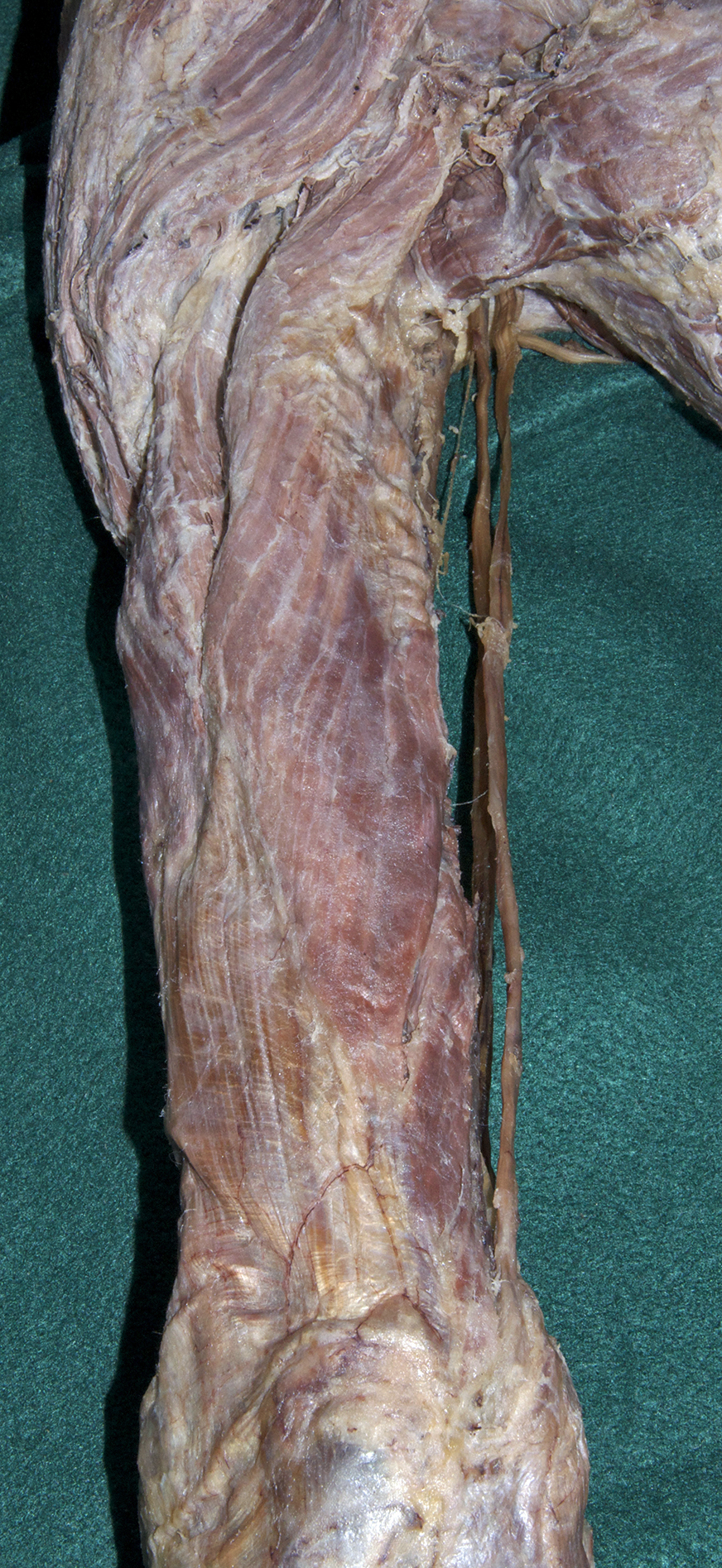 Posterior Arm - 2