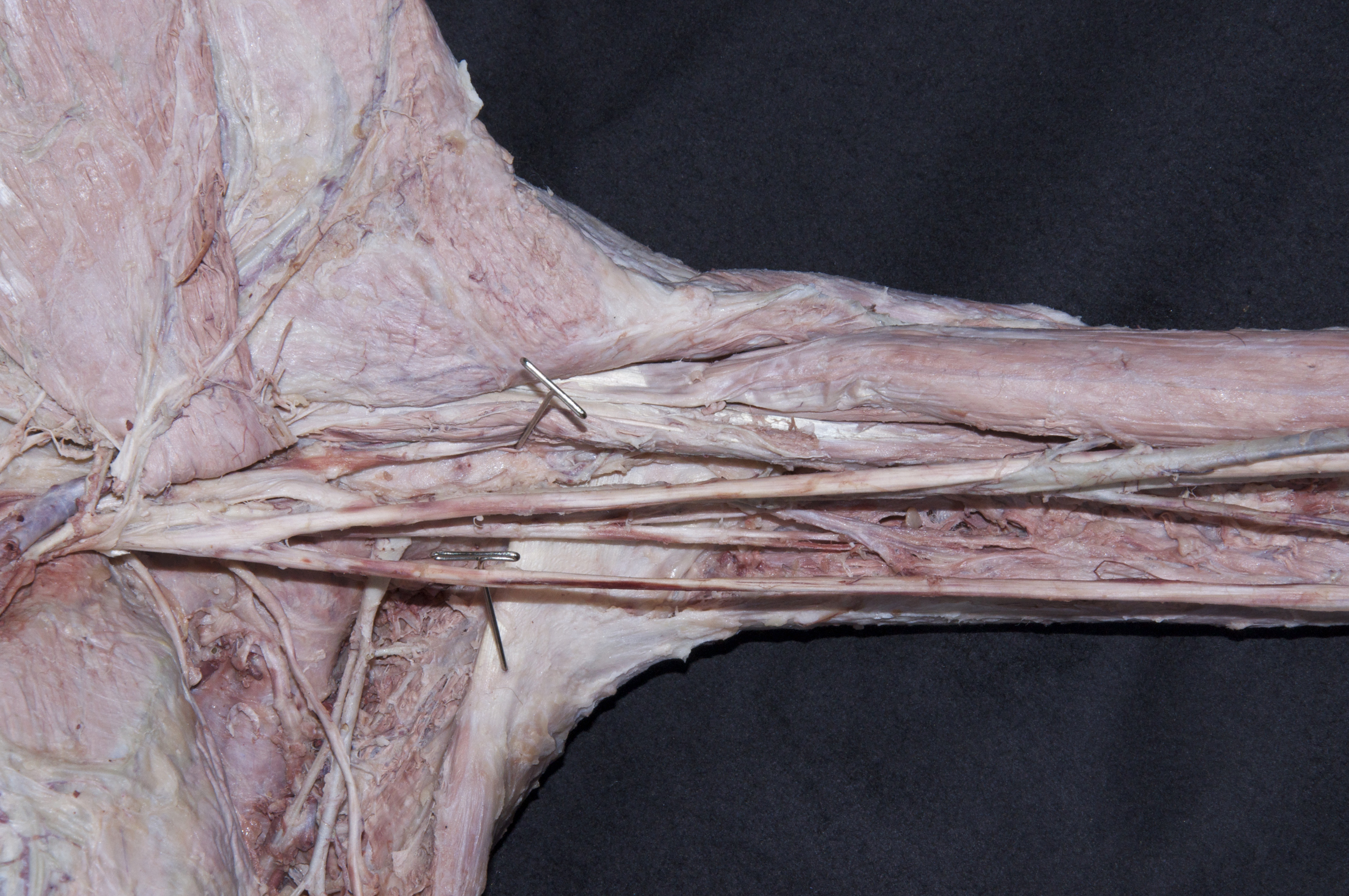 Anterior Arm - 2