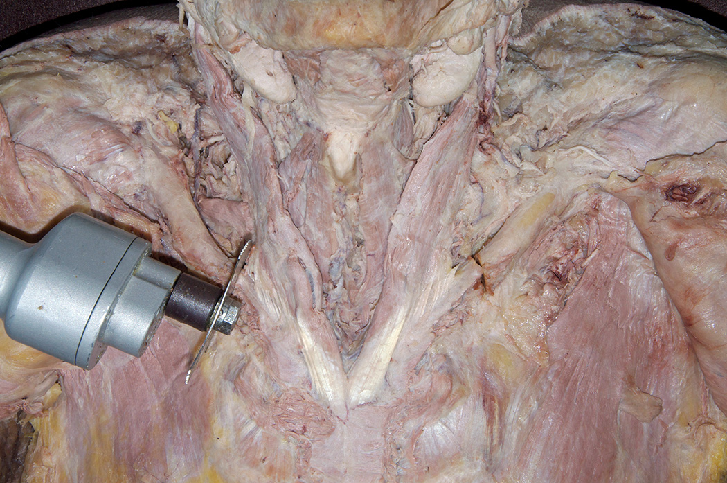 Medial Cut in Clavicle