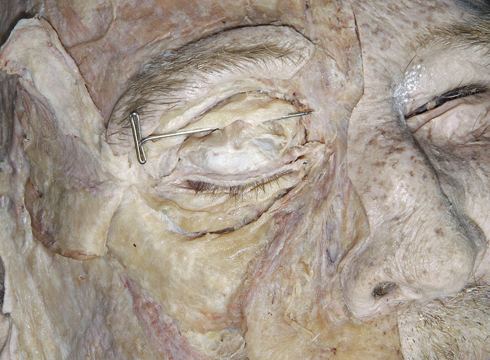 Levator Palpebrae Superioris Muscle
