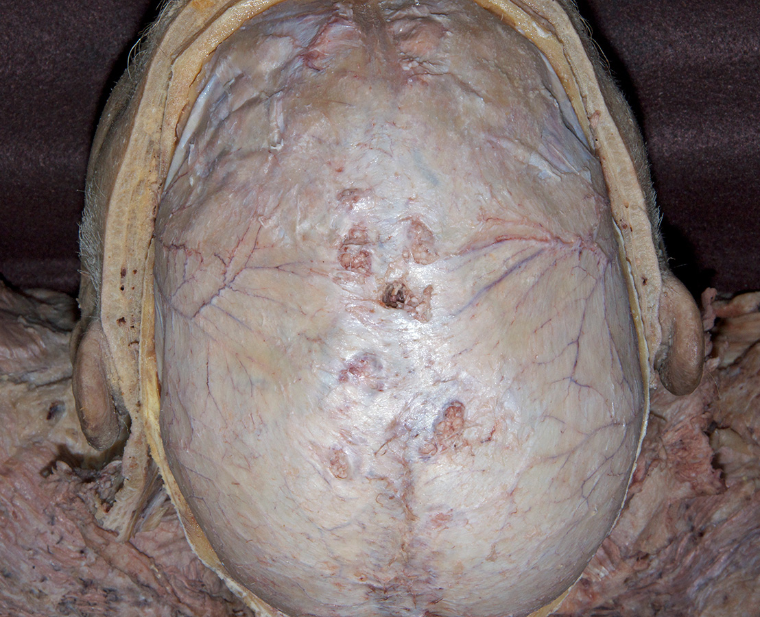 Arachnoid Granulations