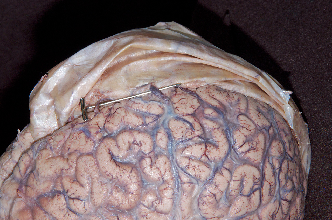 Superficial Cerebral Veins