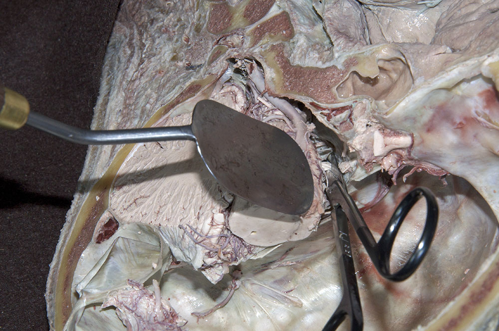 Cutting Cranial Nerves VII and VIII