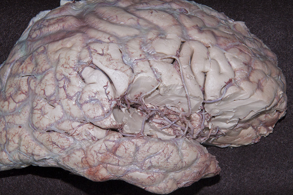 Middle Cerebral Artery in the Lateral Sulcus