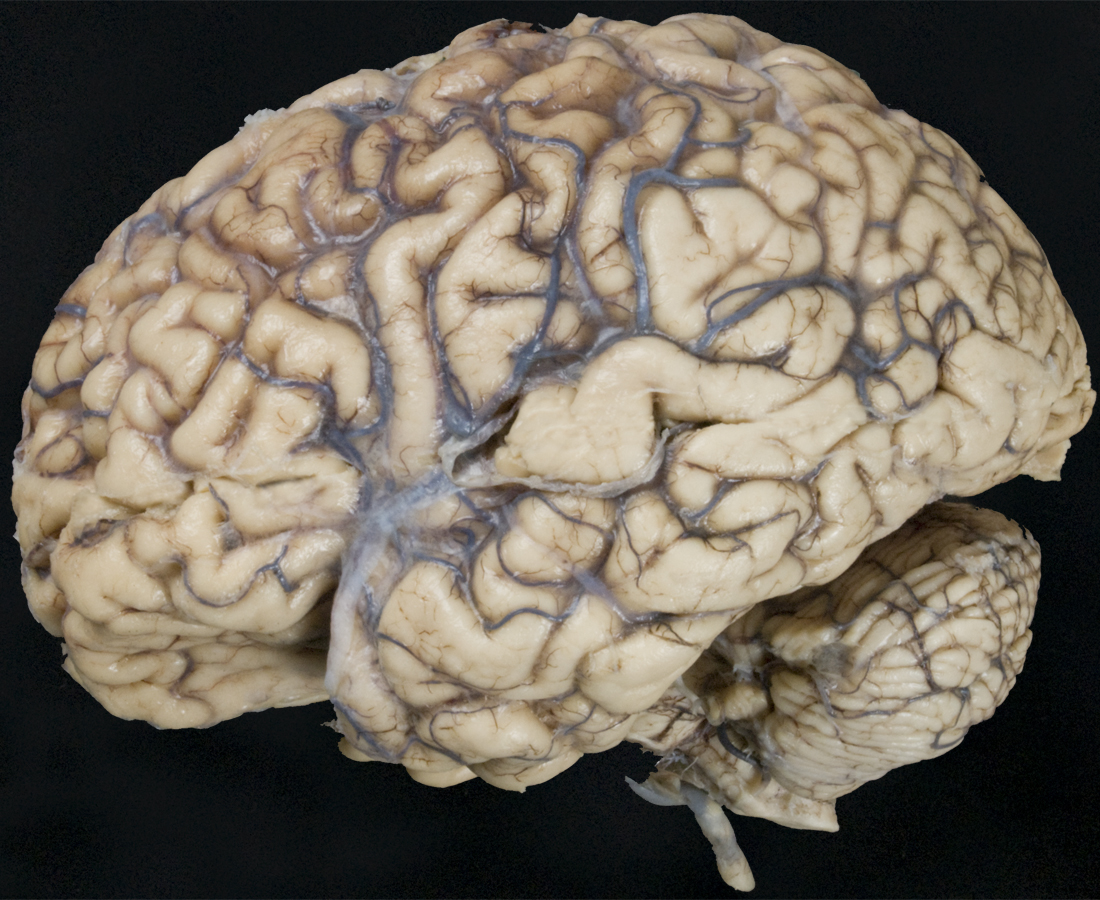 Arachnoid mater