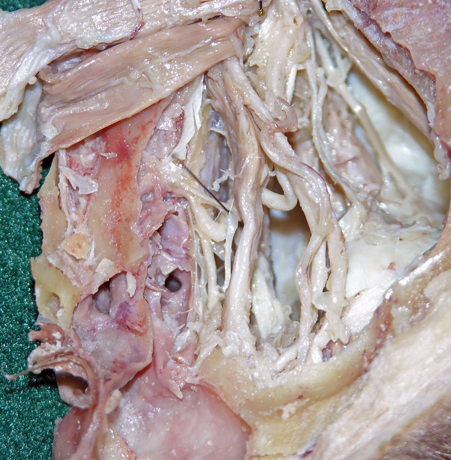 Left Anterior Ethmoidal Nerve and Artery (medial to the left)