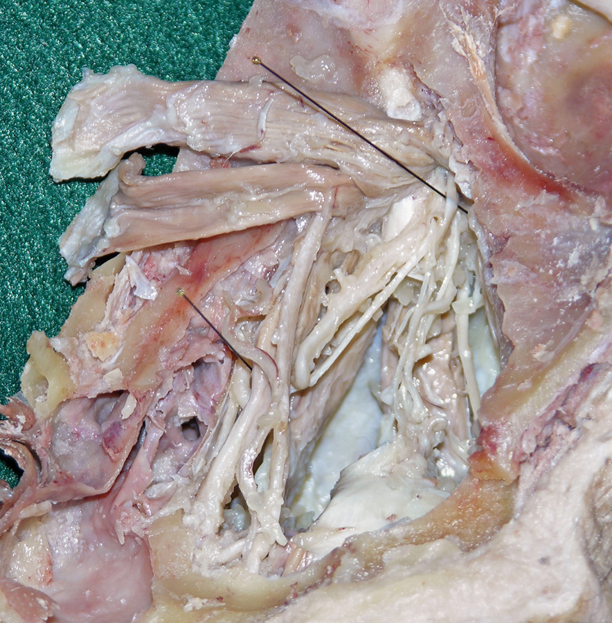 Left Nasociliary Nerve (medial to the left)