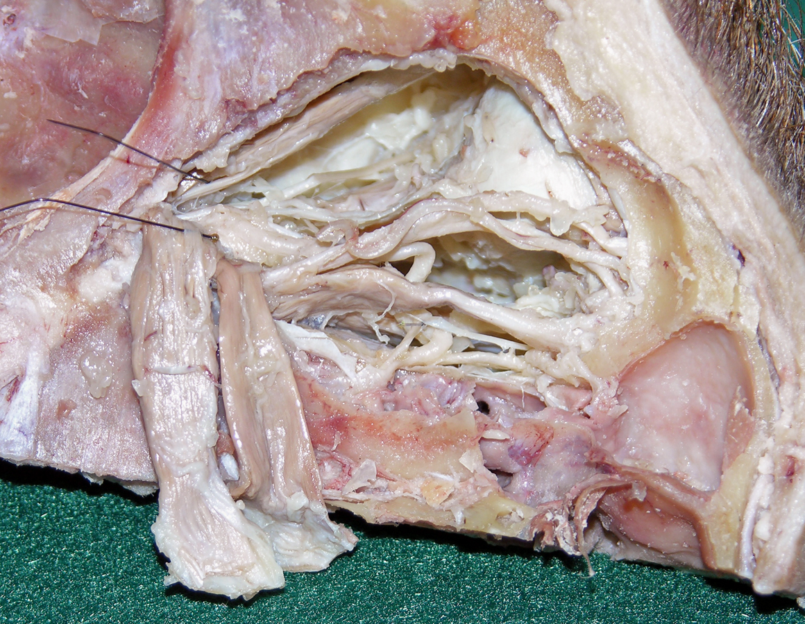 Left Oculomotor and Abducens Nerves (medial to the bottom)