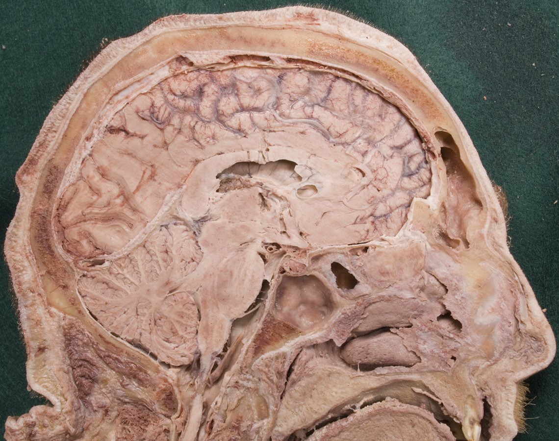 Brainstem