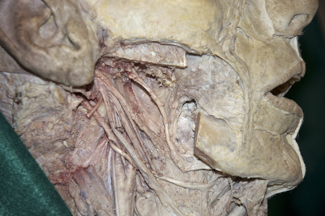 Buccinator and Superior Constrictor Muscles (mandible removed)