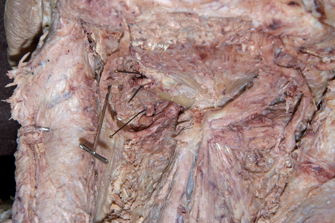 Left Vertebral Artery
