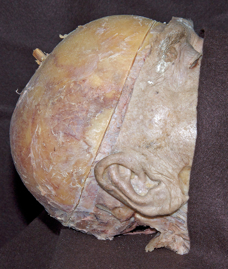 Saw Cut in Calvarium