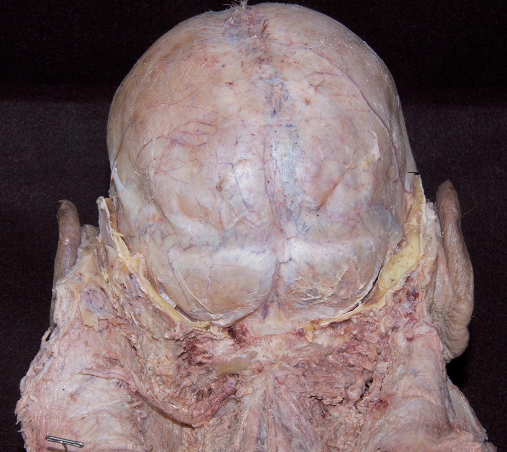 Occipital Wedge