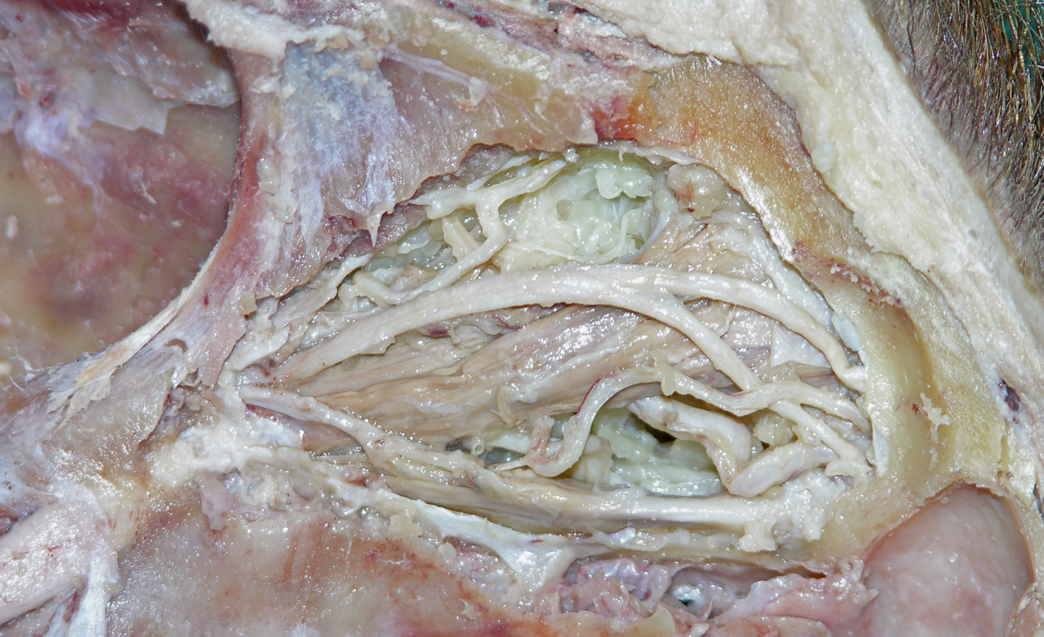 Left Frontal Nerve