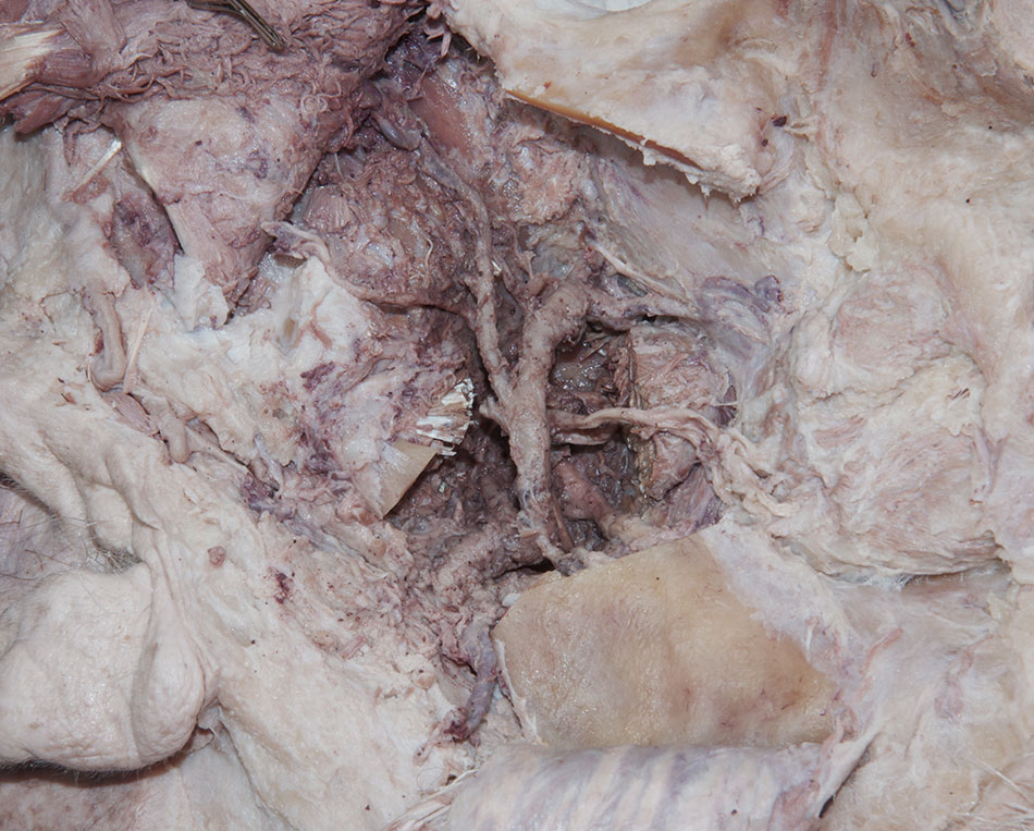 Lateral Pterygoid (cuts)