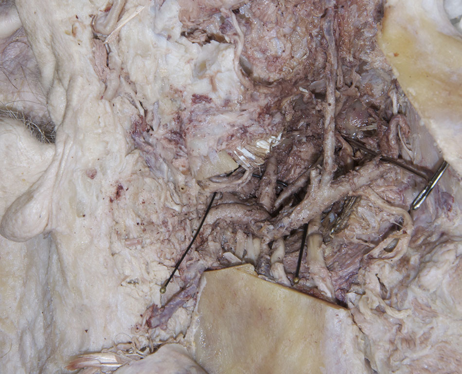 Middle Meningeal Artery
