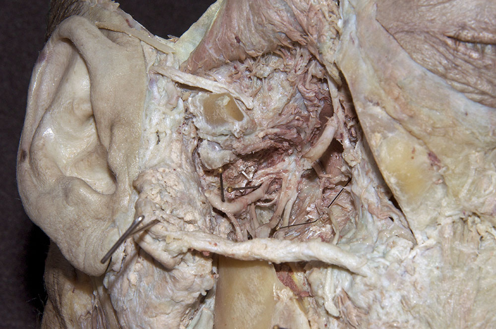 Auriculotemporal Nerve