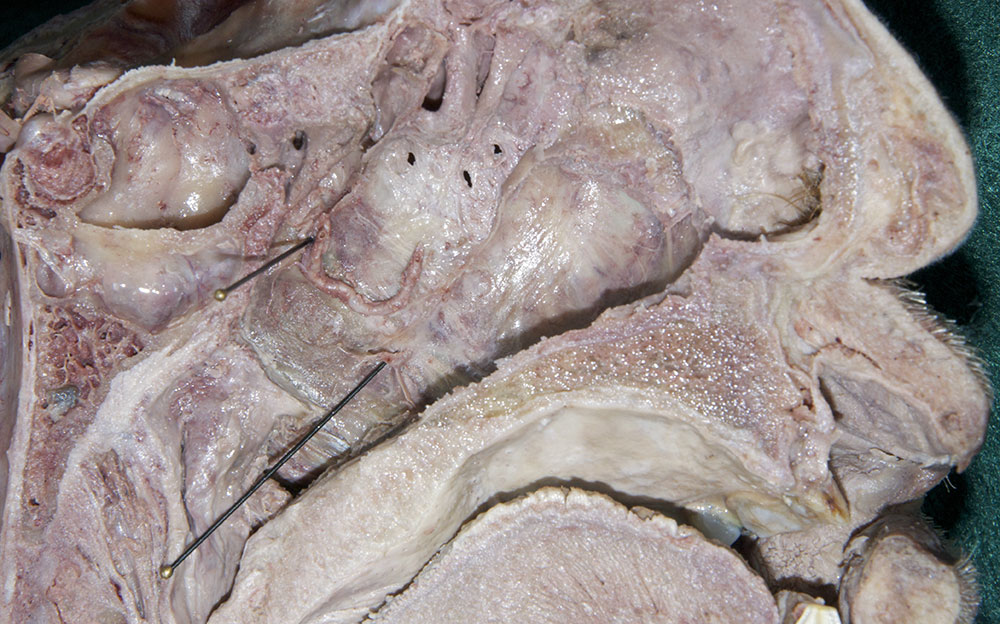Sphenopalatine Artery