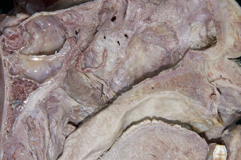 Greater Palatine Nerve and Artery