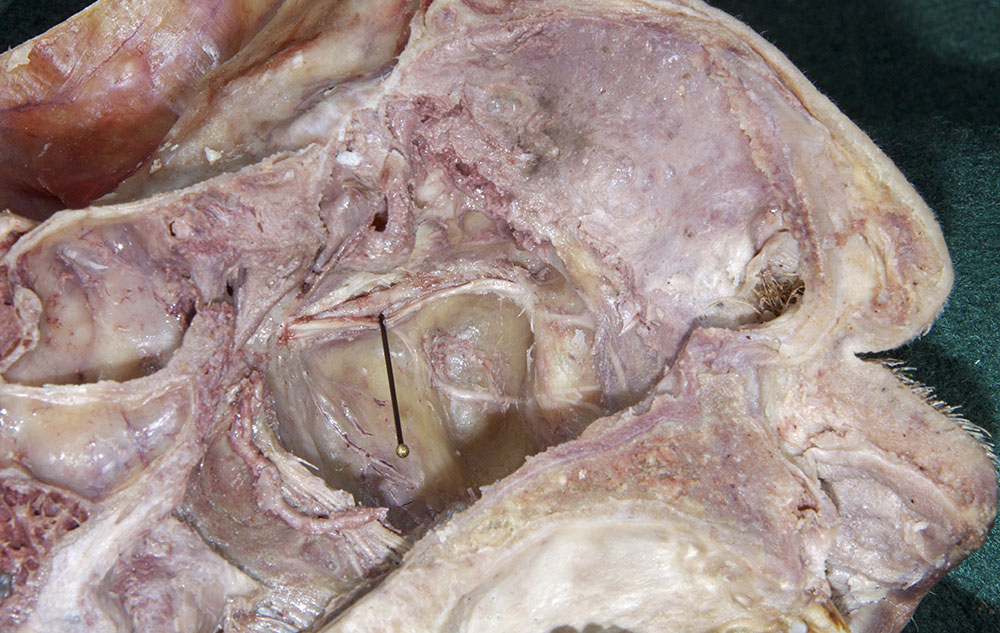Infraorbital Artery and Nerve (root of maxillary sinus)