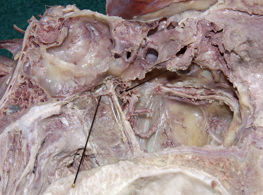 Left Pterygopalatine Ganglion (anterior-right)