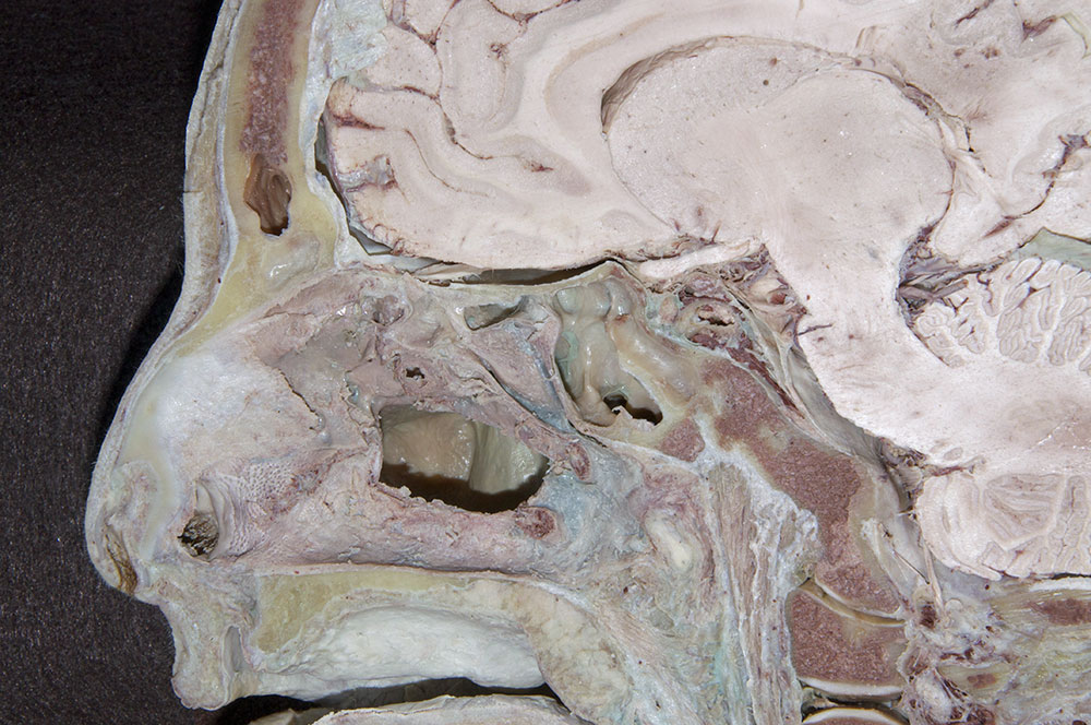 Opening the Maxillary Sinus