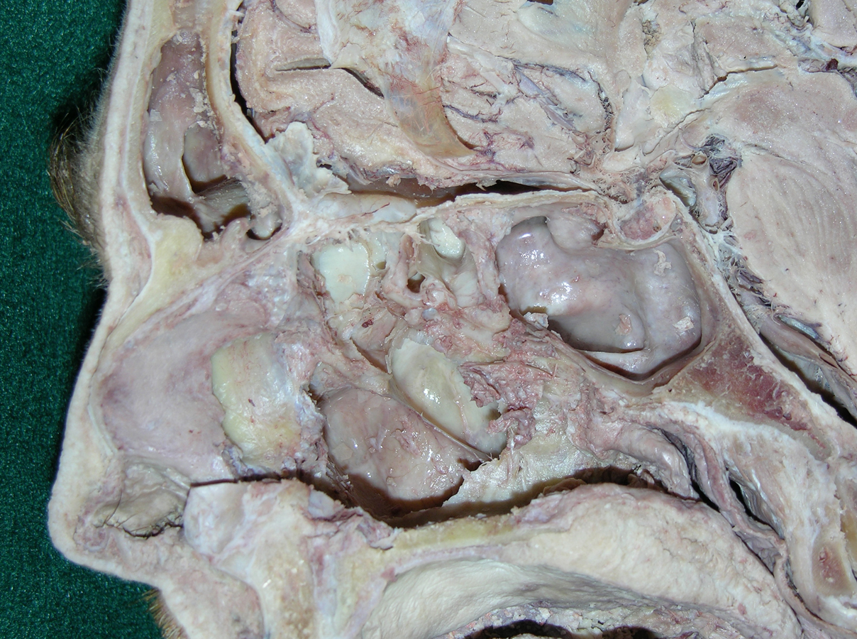 Maxillary Sinus (lateral nasal wall removed)