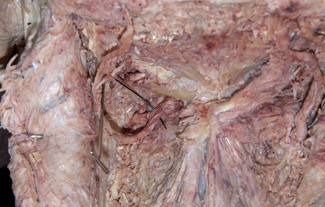 Left Dorsal Root Ganglion C2